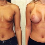 Breast Augmentation Before & After Patient #6285