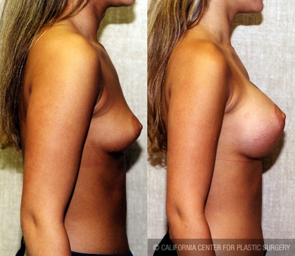 Breast Augmentation Before & After Patient #6285