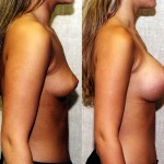 Breast Augmentation Before & After Patient #6285