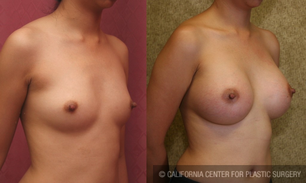 Breast Augmentation Before & After Patient #6395