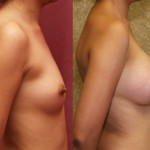 Breast Augmentation Before & After Patient #6395