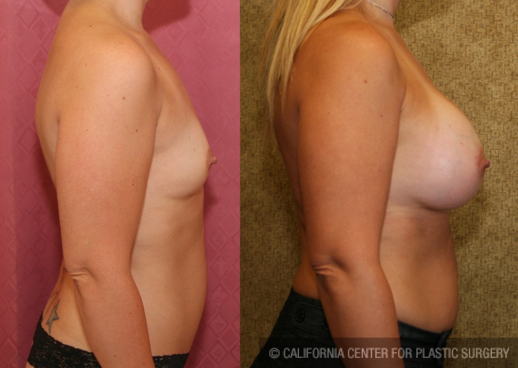 Breast Augmentation Before & After Patient #6351