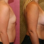 Breast Augmentation Before & After Patient #6351