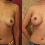 Breast Augmentation Before & After Patient #6359