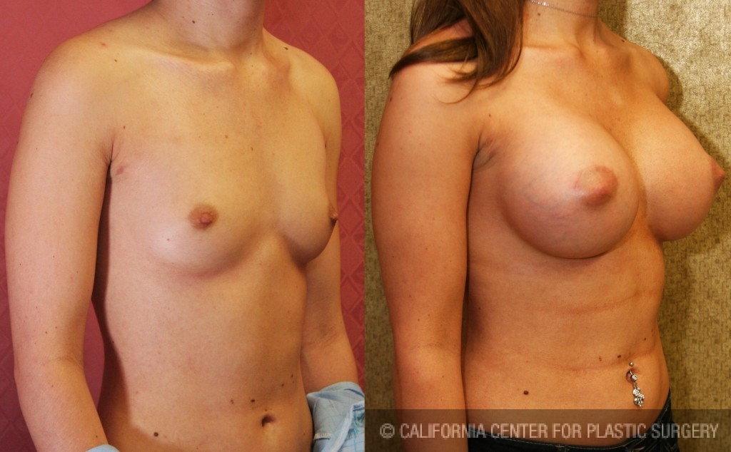 Breast Augmentation Before & After Patient #6219