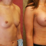 Breast Augmentation Before & After Patient #6455