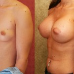 Breast Augmentation Before & After Patient #6219