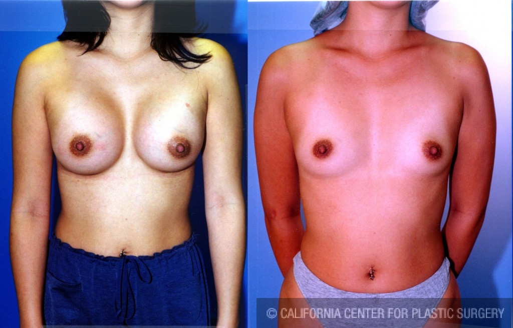 Breast Augmentation Before & After Patient #6367