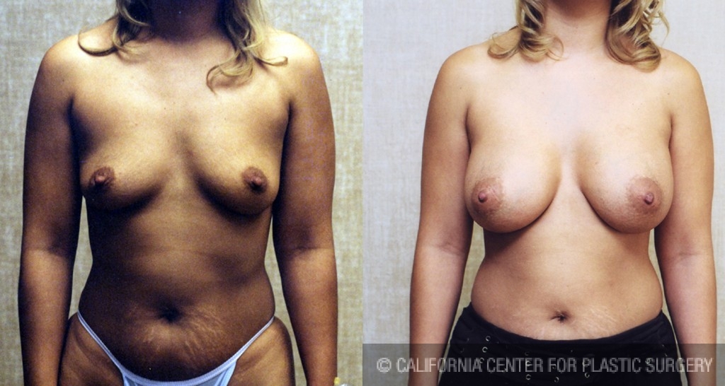 Breast Augmentation Before & After Patient #6335