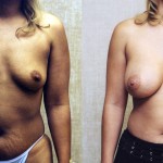 Breast Augmentation Before & After Patient #6335