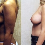 Breast Augmentation Before & After Patient #6335