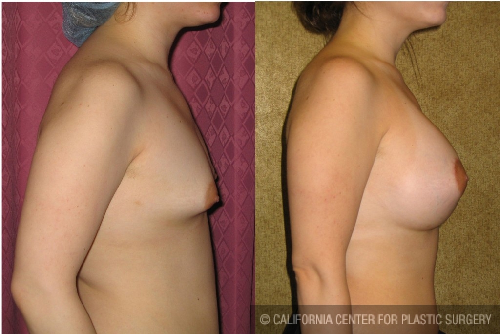 Breast Augmentation Before & After Patient #6438