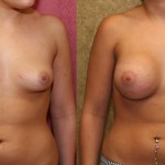 Breast Asymmetry Before & After Patient #6941