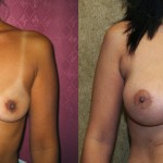 Breast Augmentation Before & After Patient #6256