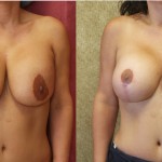 Breast Augmentation (Revision) Before & After Patient #6558