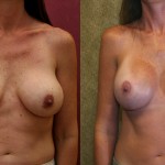 Breast Augmentation (Revision) Before & After Patient #6551