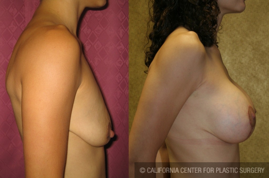 Breast Lift - Full Before & After Patient #6709
