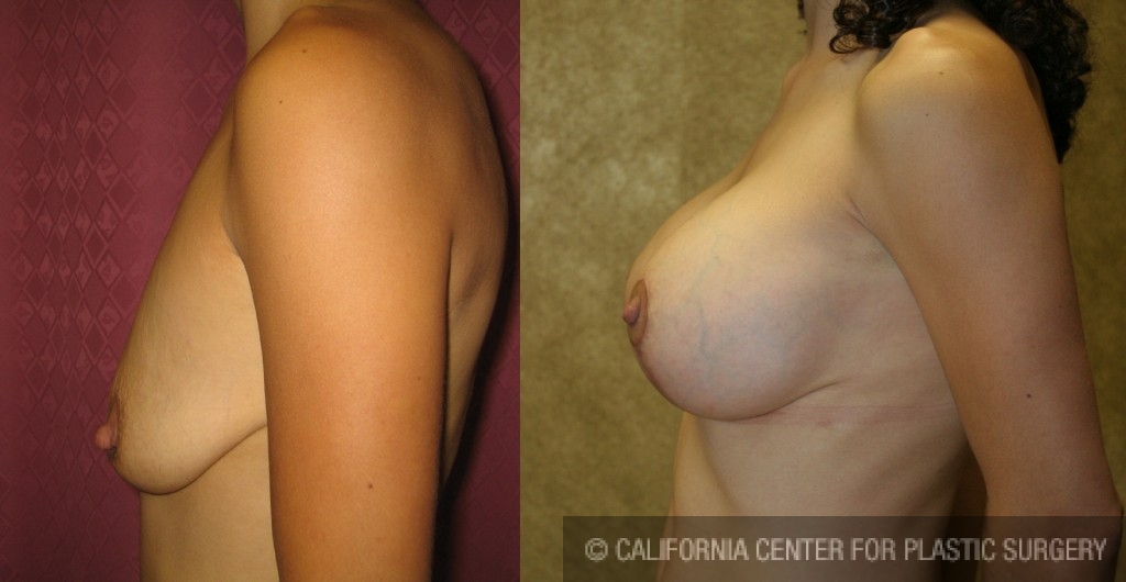 Breast Lift - Full Before & After Patient #6709