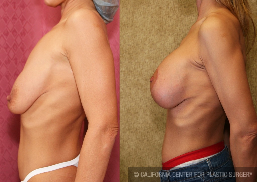 Breast Lift - Full Before & After Patient #6717