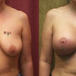 Breast Lift - Full Before & After Patient #6738