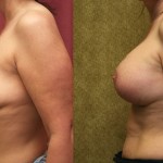 Breast Lift - Full Before & After Patient #6738