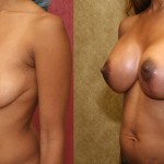 Breast Lift - Full Before & After Patient #6819