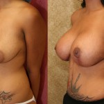 Breast Lift - Full Before & After Patient #6915
