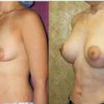 Breast Lift - Limited Before & After Patient #6582