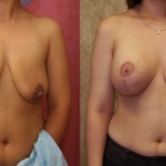 Breast Lift - Full Before & After Patient #6919