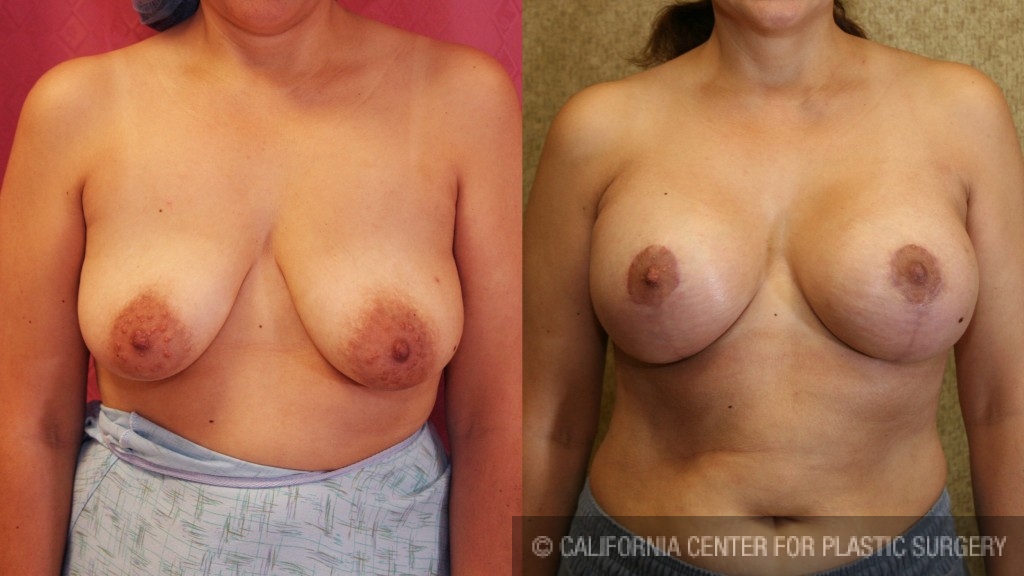 Breast Lift - Full Before & After Patient #6925