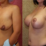 Breast Lift - Full Before & After Patient #6919