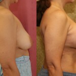 Breast Lift - Full Before & After Patient #6925