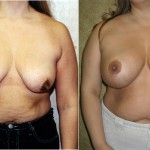 Breast Lift - Full Before & After Patient #6937