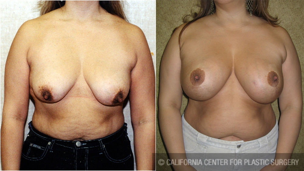 Breast Lift - Full Before & After Patient #6937