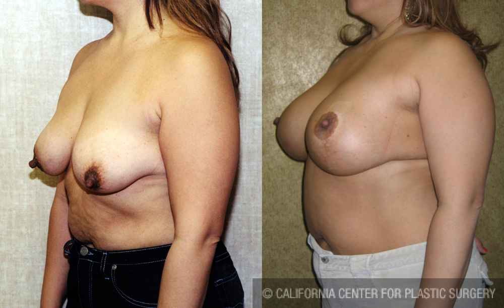 Breast Lift - Full Before & After Patient #6937
