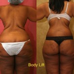 Body Lift Before & After Patient #6058