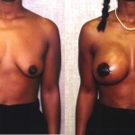 Breast Lift - Moderate Before & After Patient #6626