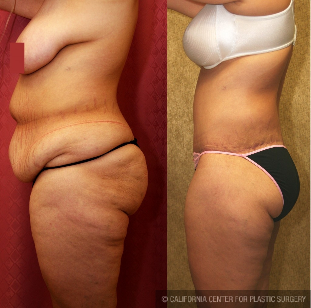 Patient #6036 Body Lift Before and After Photos Beverly Hills