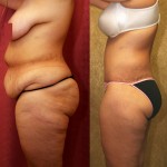 Body Lift Before & After Patient #6036