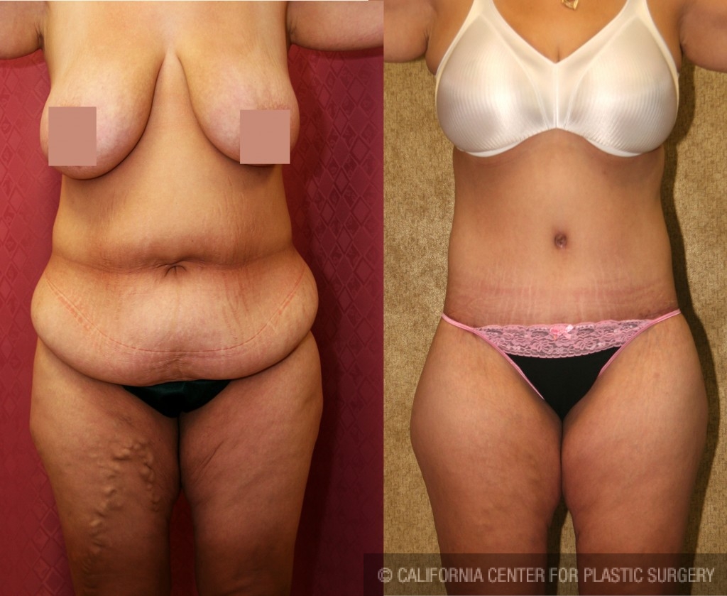 Body Lift Before & After Patient #6036