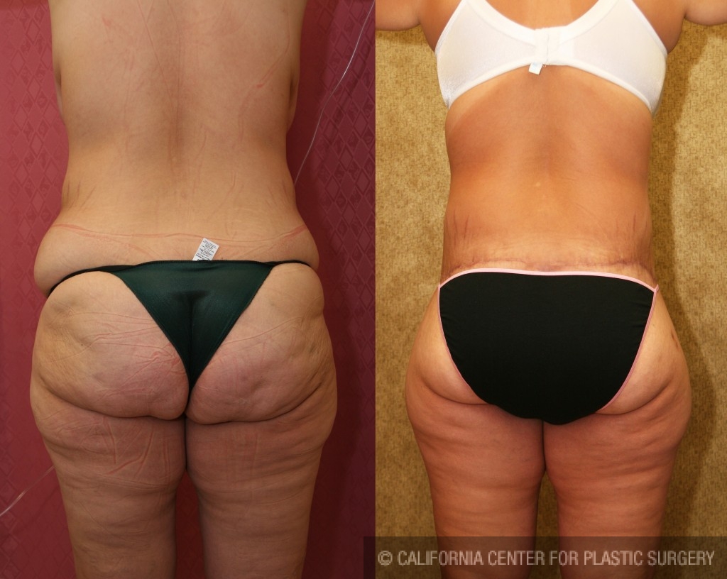 Body Lift Before and After Pictures Case 146, Guilford, CT