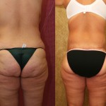 Body Lift Before & After Patient #6036