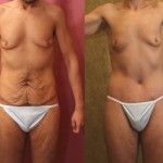 Body Lift Before & After Patient #6061