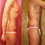 Body Lift Before & After Patient #6061