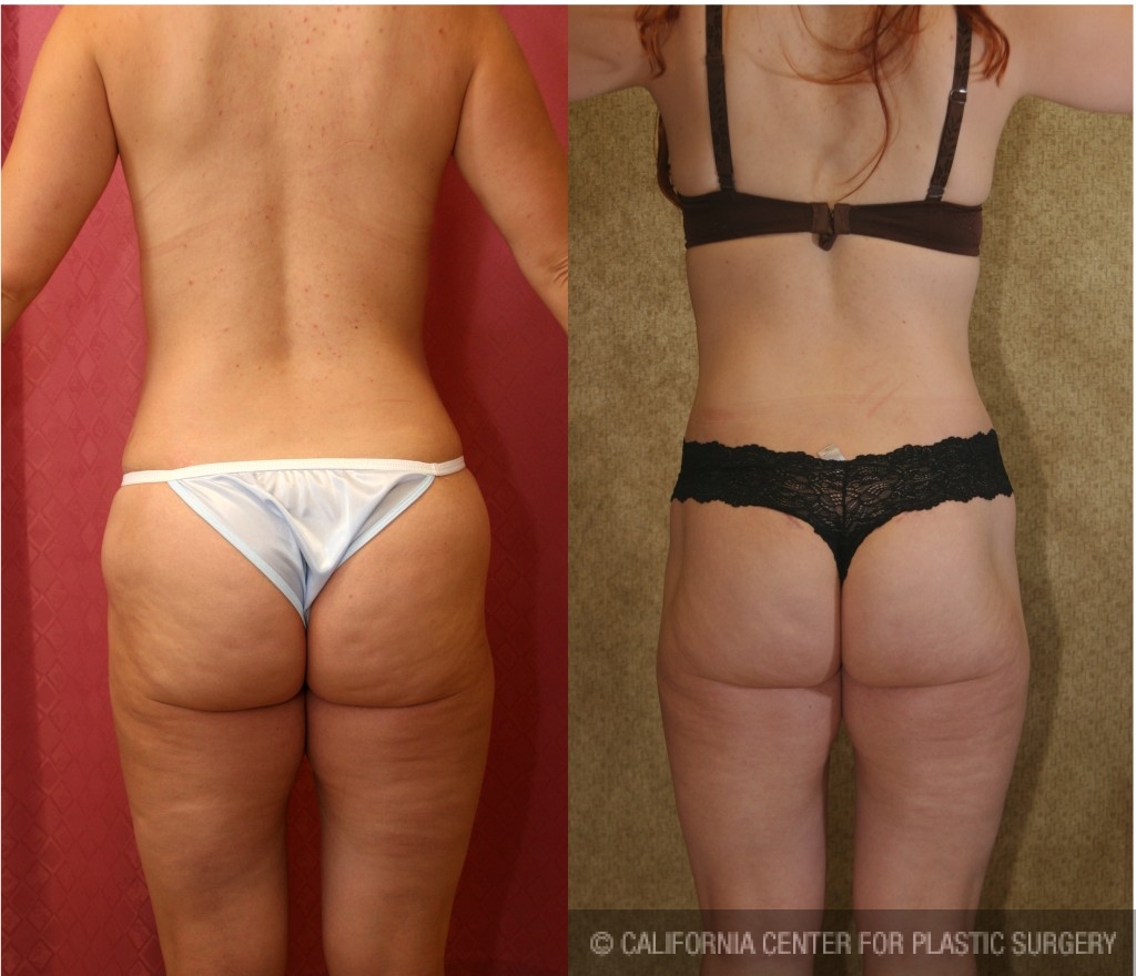 Lower Body Lift Before & After Patient 78, NYC