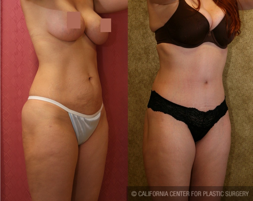 Body Lift Before & After Patient #6051