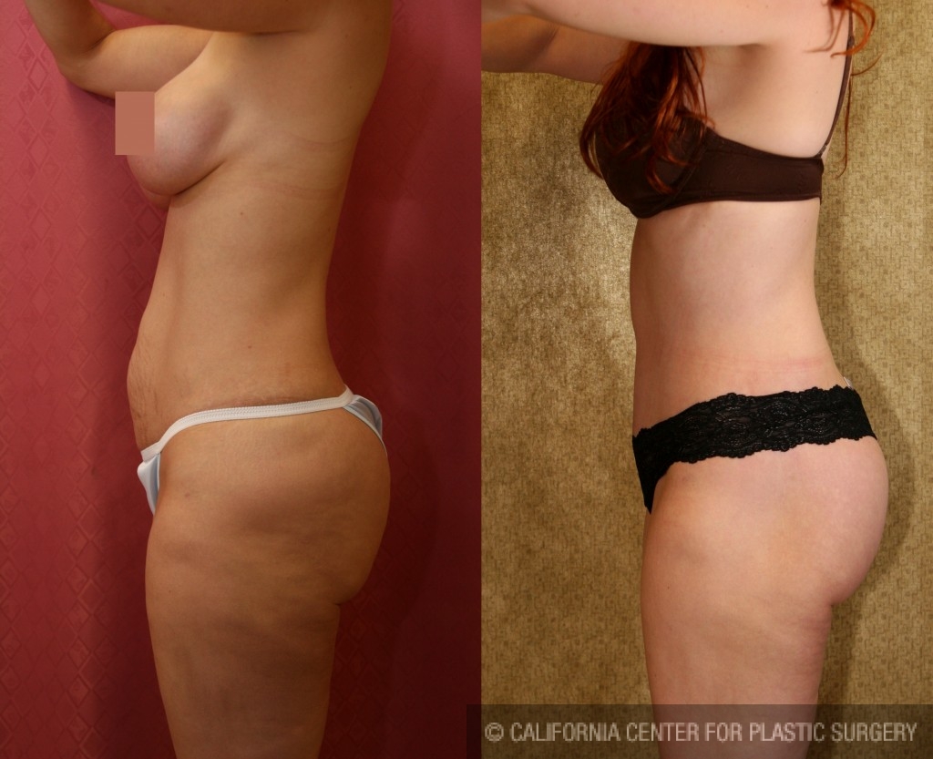 Body Lift Before & After Patient #6051