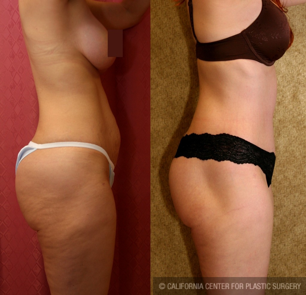 Body Lift Before & After Patient #6051