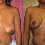 Breast Lift (Mastopexy) Before & After Patient #6692