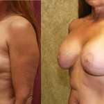 Breast Lift - Limited Before & After Patient #6593